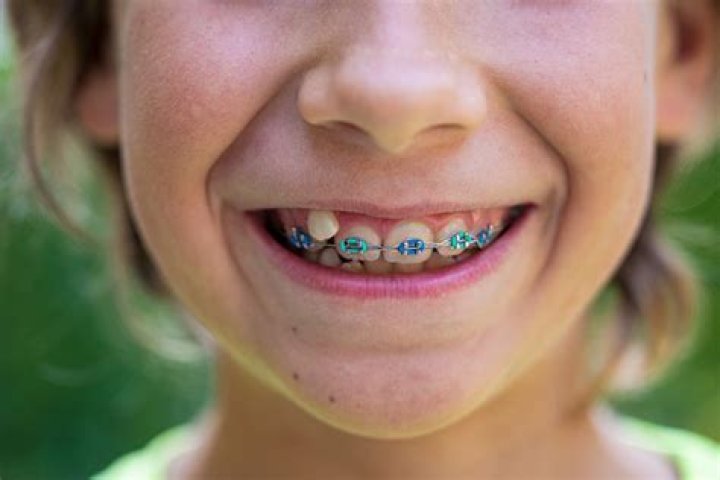 Can a 5 year old get braces?